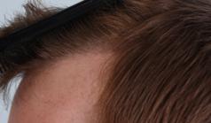 Before Hair Transplant&nbsp;Hairlines